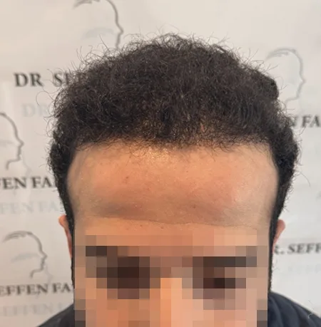 Patient 89 — 3,765 grafts · Norwood 6 · age 24, after hair transplant