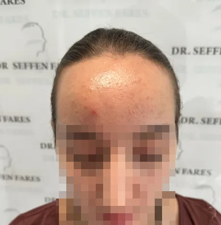 Patient 88 — 2,343 grafts · age 29, before hair transplant