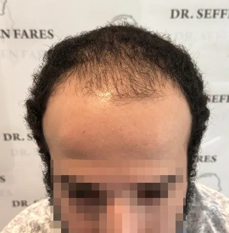 Patient 89 — 3,765 grafts · Norwood 6 · age 24, before hair transplant