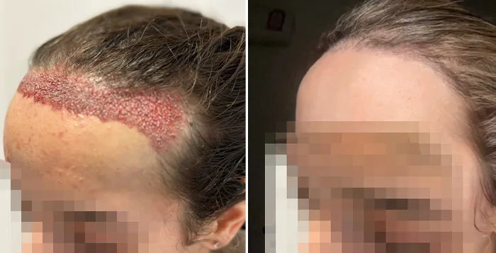 Patient 88, before and after hair transplant, view 3