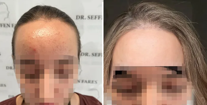 Patient 88, before and after hair transplant, view 1