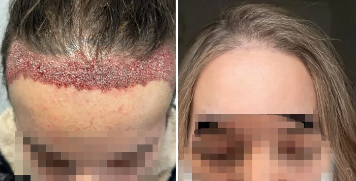 Patient 88, before and after hair transplant, view 2