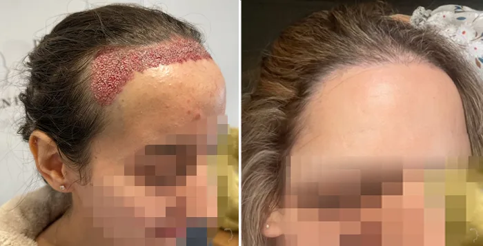 Patient 88, before and after hair transplant, view 4