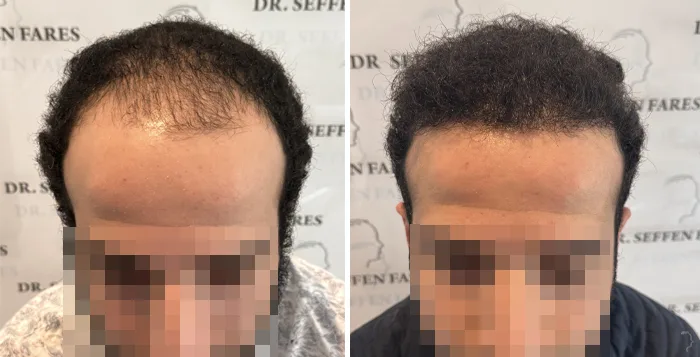 Patient 89, avant et après greffe de cheveux, vue 1