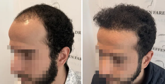 Patient 89, avant et après greffe de cheveux, vue 2
