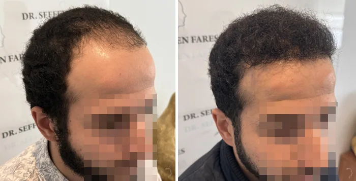 Patient 89, avant et après greffe de cheveux, vue 3