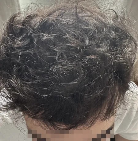 Patient 90 — 3,895 grafts · Norwood 5 · age 29, after hair transplant