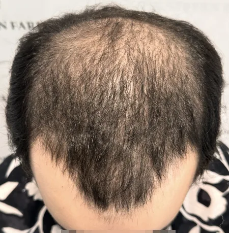 Patient 90 — 3,895 grafts · Norwood 5 · age 29, before hair transplant