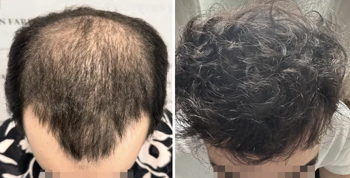 Patient 90, before and after hair transplant, view 2