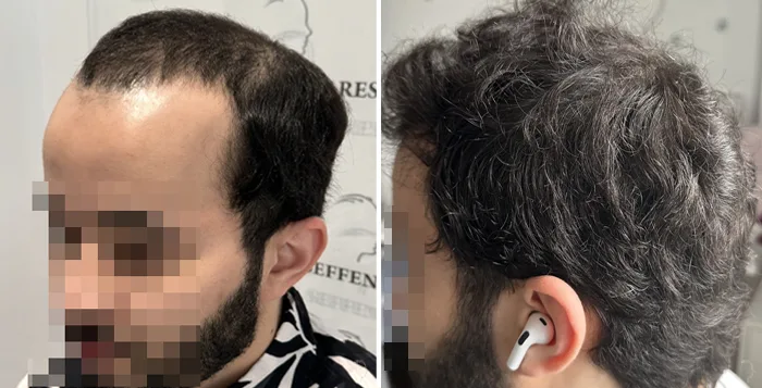 Patient 90, before and after hair transplant, view 4