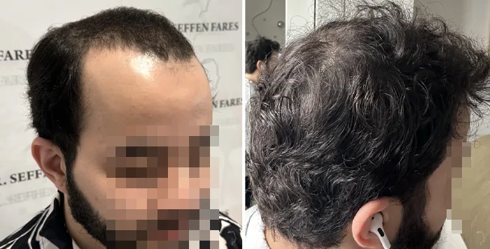Patient 90, before and after hair transplant, view 3