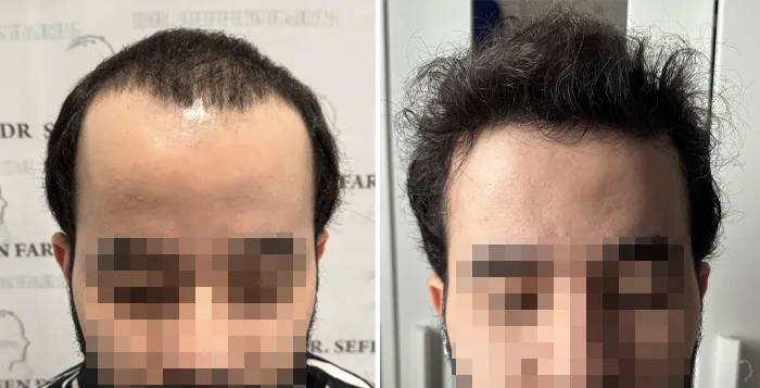 Patient 90, before and after hair transplant, view 1