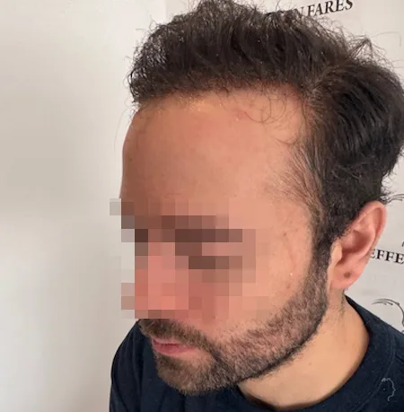 Patient 91 — 3,455 grafts · Norwood 5 · age 33, after hair transplant