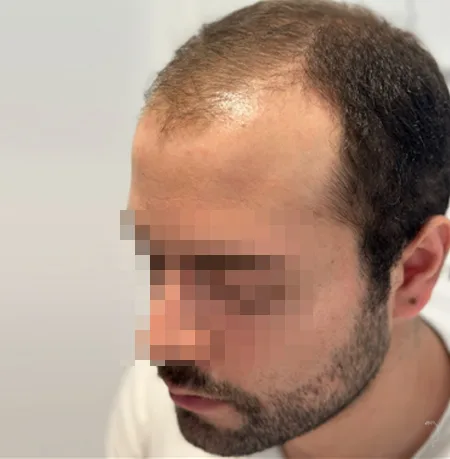 Patient 91 — 3,455 grafts · Norwood 5 · age 33, before hair transplant