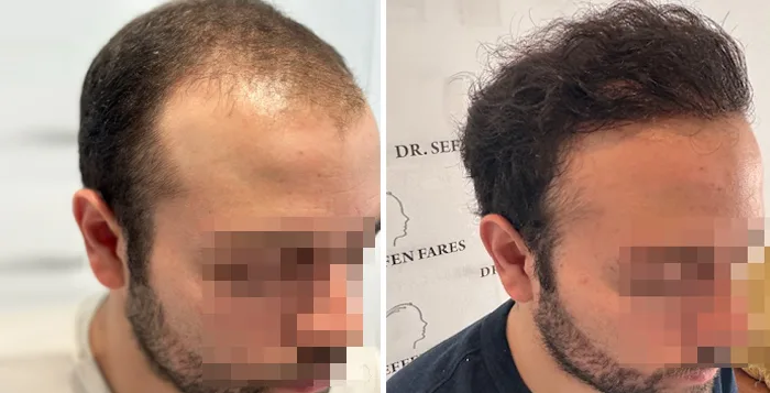Patient 91, before and after hair transplant, view 2