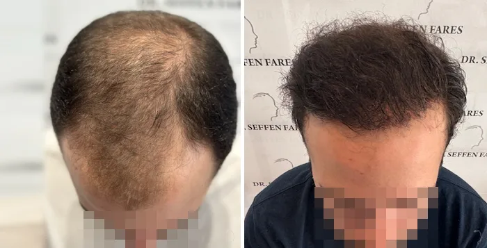 Patient 91, before and after hair transplant, view 4