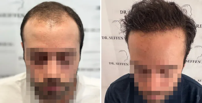 Patient 91, before and after hair transplant, view 1