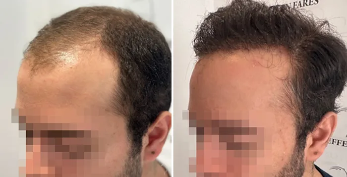 Patient 91, before and after hair transplant, view 3