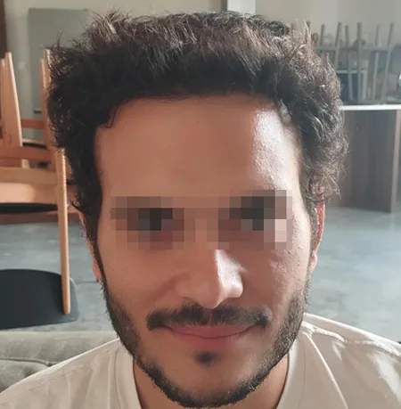 Patient 92 — 3,077 grafts · Norwood 3 · age 33, after hair transplant