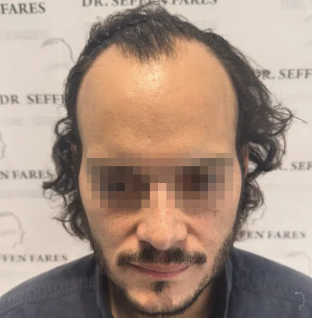 Patient 92 — 3,077 grafts · Norwood 3 · age 33, before hair transplant