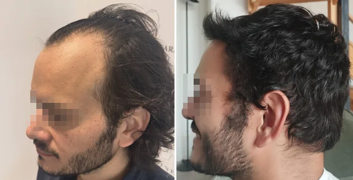 Patient 92, before and after hair transplant, view 3