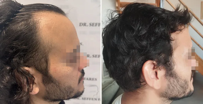 Patient 92, before and after hair transplant, view 2