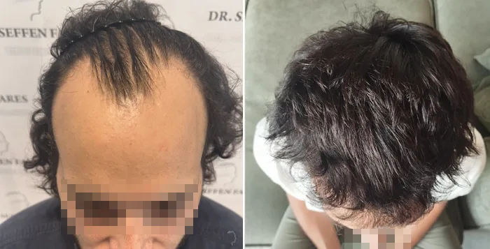 Patient 92, before and after hair transplant, view 4