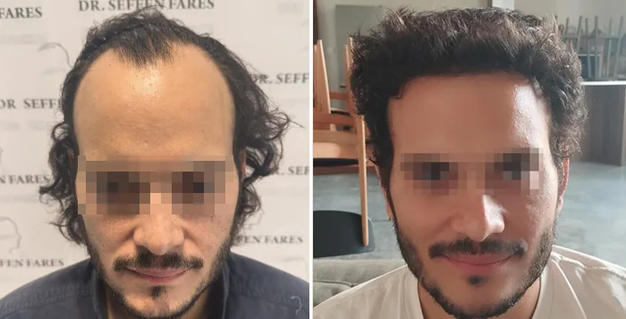 Patient 92, before and after hair transplant, view 1