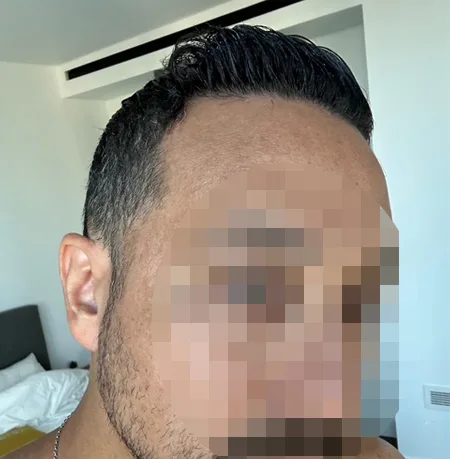 Patient 93 — 3,655 grafts · Norwood 5 · age 36, after hair transplant