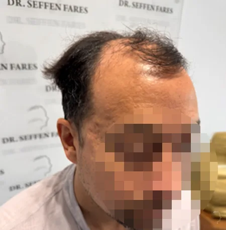 Patient 93 — 3,655 grafts · Norwood 5 · age 36, before hair transplant