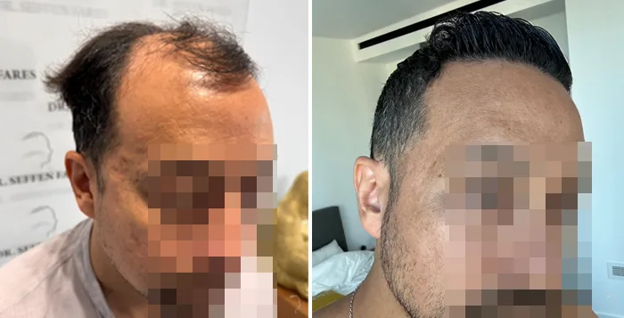Patient 93, before and after hair transplant, view 4