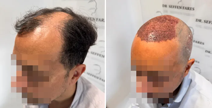 Patient 93, before and after hair transplant, view 3