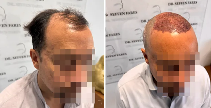 Patient 93, before and after hair transplant, view 2