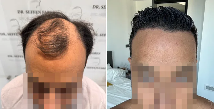 Patient 93, before and after hair transplant, view 1