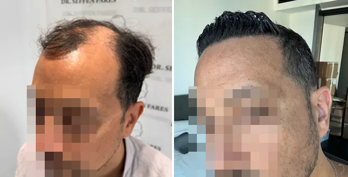 Patient 93, before and after hair transplant, view 5