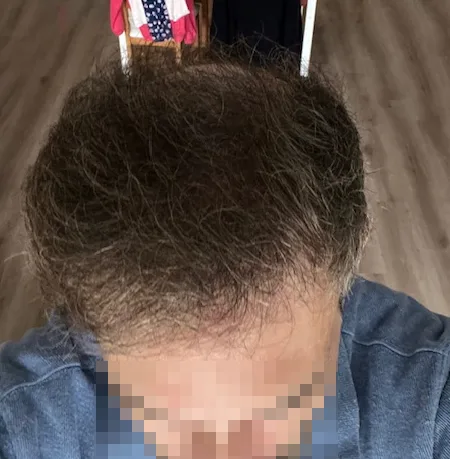 Patient 94 — 4,113 grafts · Norwood 6 · age 43, after hair transplant