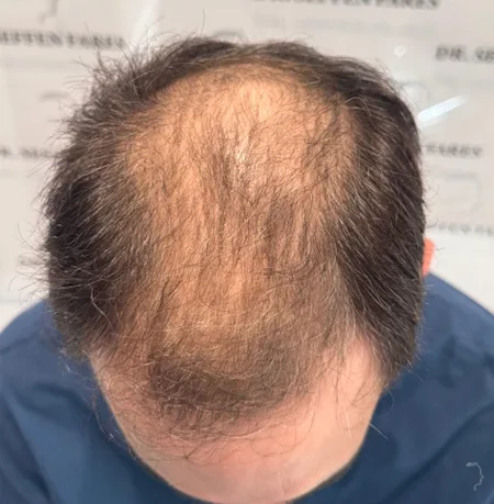 Patient 94 — 4,113 grafts · Norwood 6 · age 43, before hair transplant