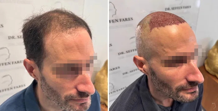 Patient 94, avant et après greffe de cheveux, vue 5