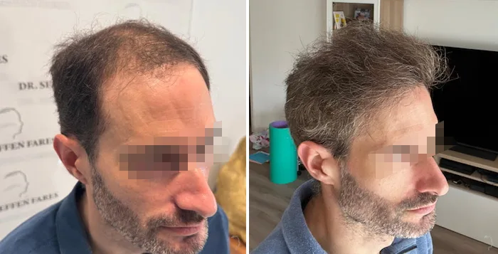 Patient 94, avant et après greffe de cheveux, vue 6
