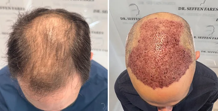 Patient 94, avant et après greffe de cheveux, vue 1