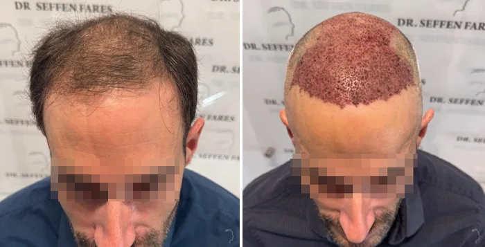 Patient 94, avant et après greffe de cheveux, vue 3