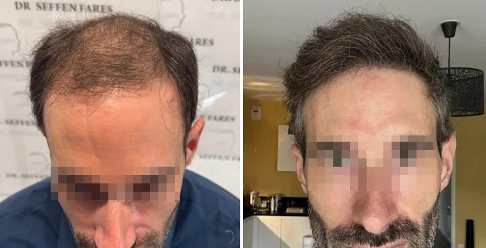 Patient 94, avant et après greffe de cheveux, vue 4