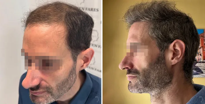 Patient 94, avant et après greffe de cheveux, vue 7