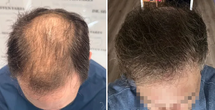 Patient 94, avant et après greffe de cheveux, vue 2
