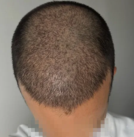 Patient 95 — 3,026 grafts · Norwood 3 · age 35, after hair transplant