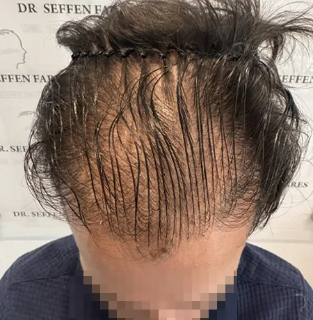 Patient 95 — 3,026 grafts · Norwood 3 · age 35, before hair transplant