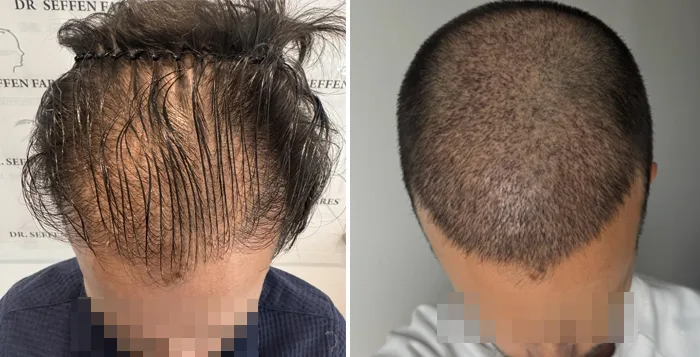 Patient 95, before and after hair transplant, view 1