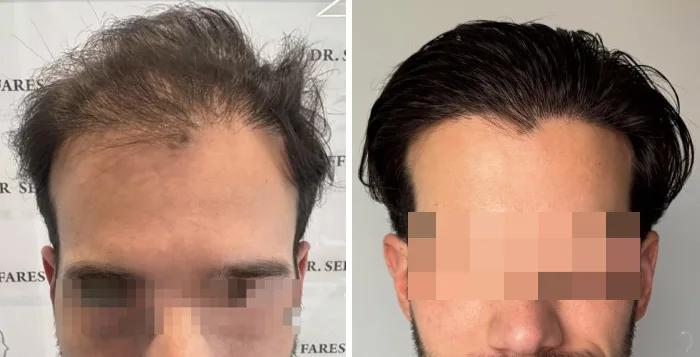 Patient 95, before and after hair transplant, view 3