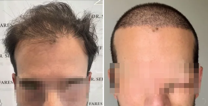 Patient 95, before and after hair transplant, view 2