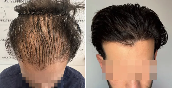 Patient 95, before and after hair transplant, view 4